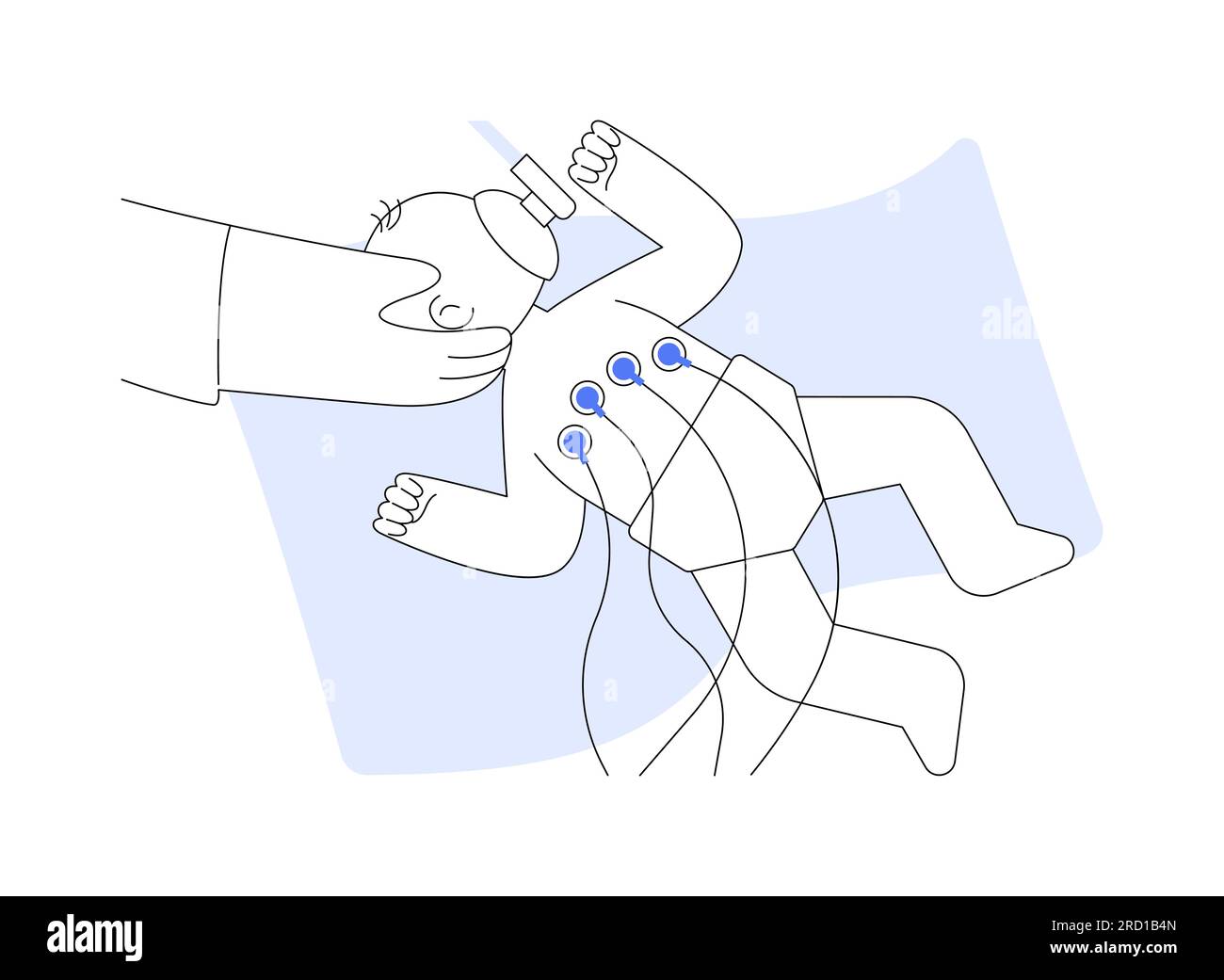 Illustration vectorielle abstraite de la chirurgie néonatale. Illustration de Vecteur