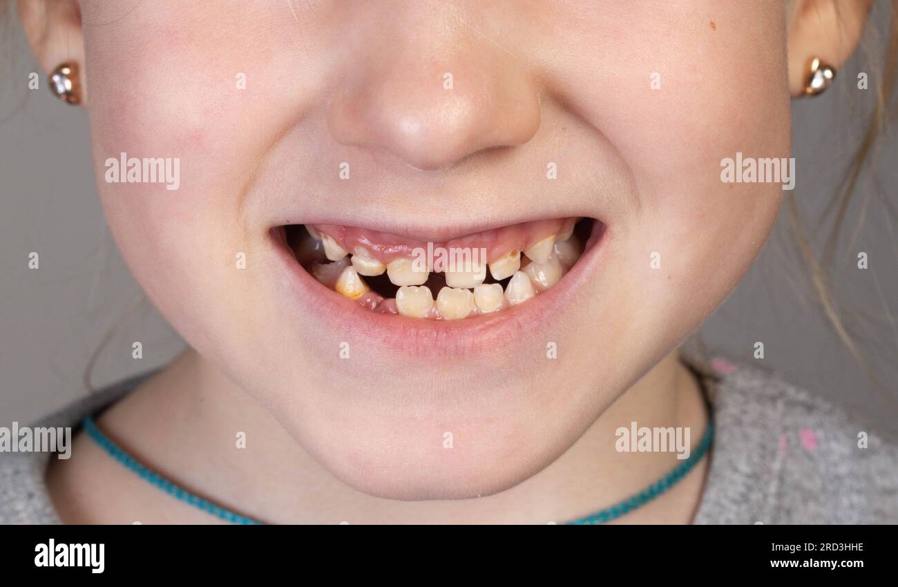 Le sourire d'une fille sans dent. Extraction des dents de lait chez les enfants. Banque D'Images