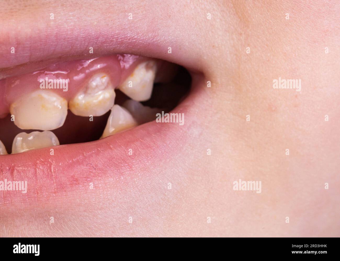 Bouche et sourire d'un enfant sans une dent. Perte de dents de lait chez les enfants Banque D'Images