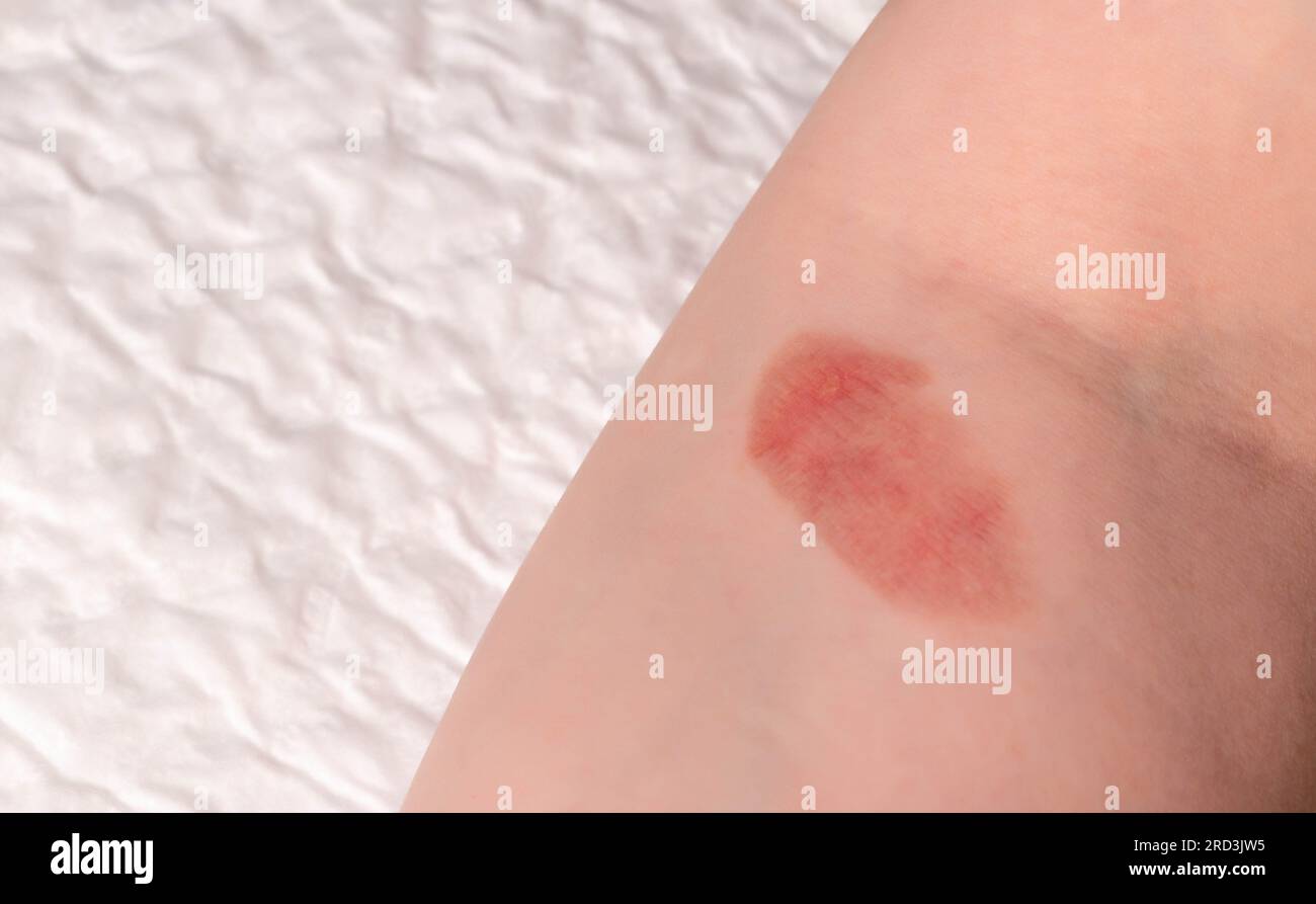 Tache rouge sur la peau, lésions cutanées dues à une brûlure sur le bras Photo Stock Alamy