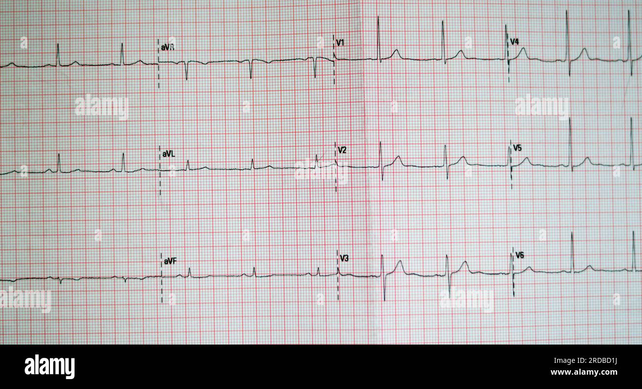 Papier électrocardiographique ECG montrant une anomalie du rythme sinusal d'hypertrophie ventriculaire droite, une onde T inférieure due à une hypertrophie et une ischémie, AB Banque D'Images