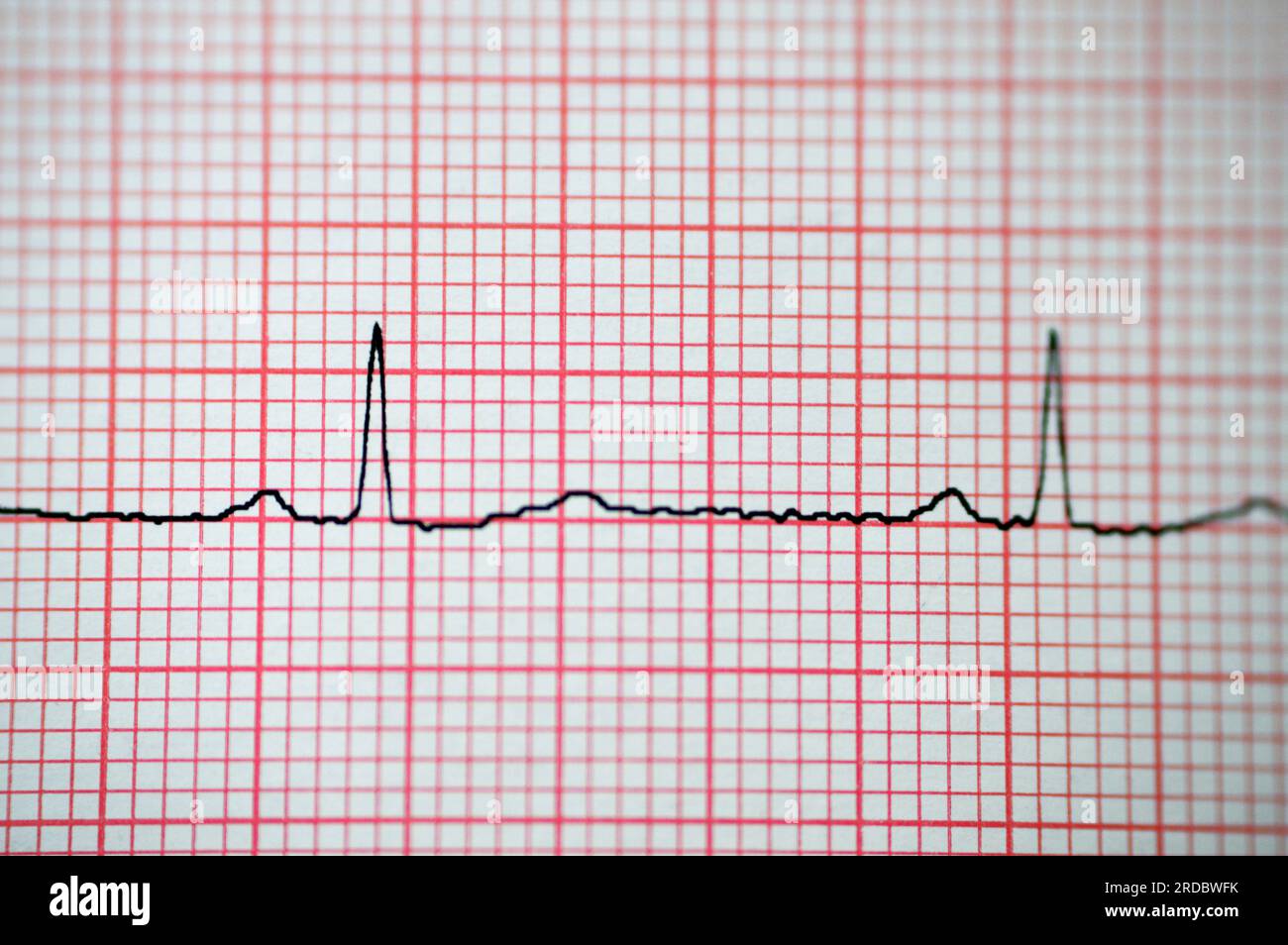Papier électrocardiographique ECG montrant une anomalie du rythme sinusal d'hypertrophie ventriculaire droite, une onde T inférieure due à une hypertrophie et une ischémie, AB Banque D'Images