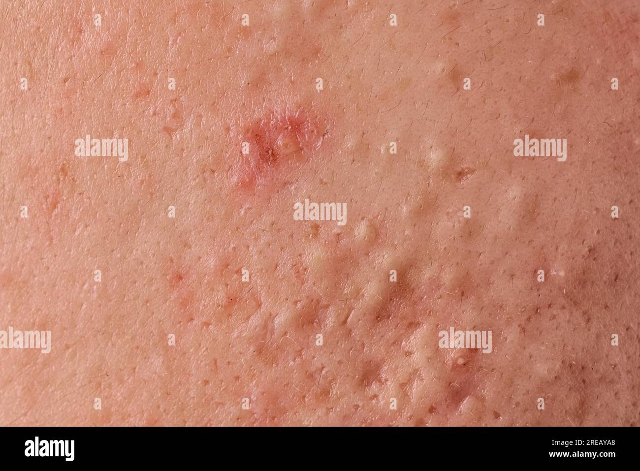 Jeune personne avec problème d'acné, vue rapprochée de la peau Banque D'Images