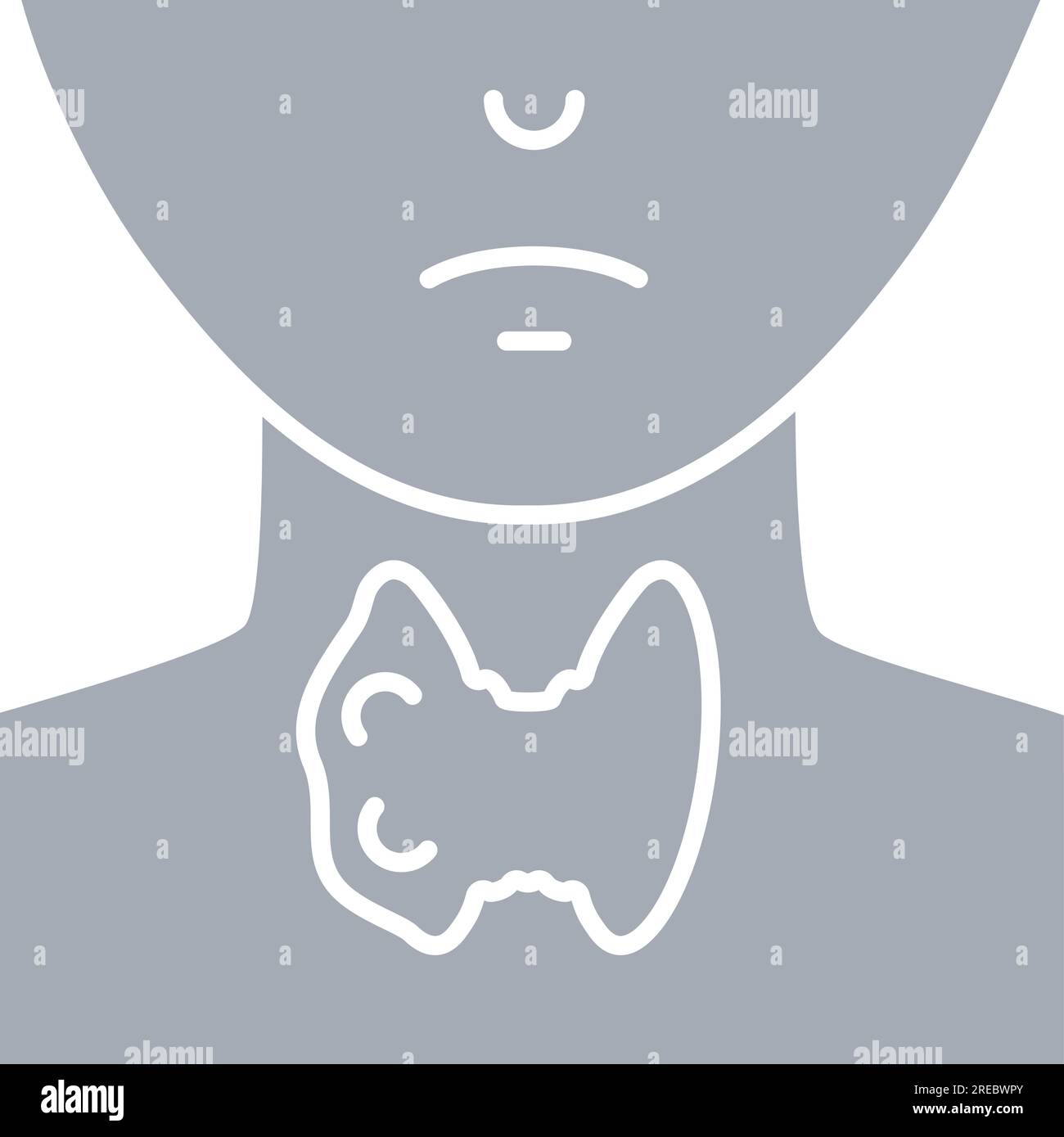 Hypertrophie de la glande thyroïde sur le schéma de silhouette du cou Illustration de Vecteur
