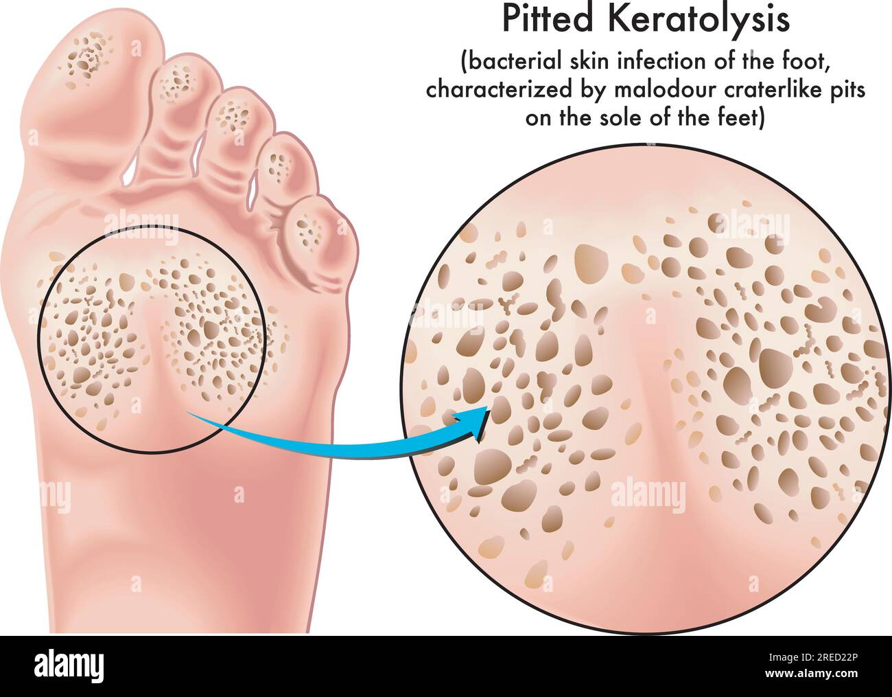 Illustration médicale des symptômes d'une kératolyse dénoyautée, infection cutanée bactérienne du pied. Illustration de Vecteur