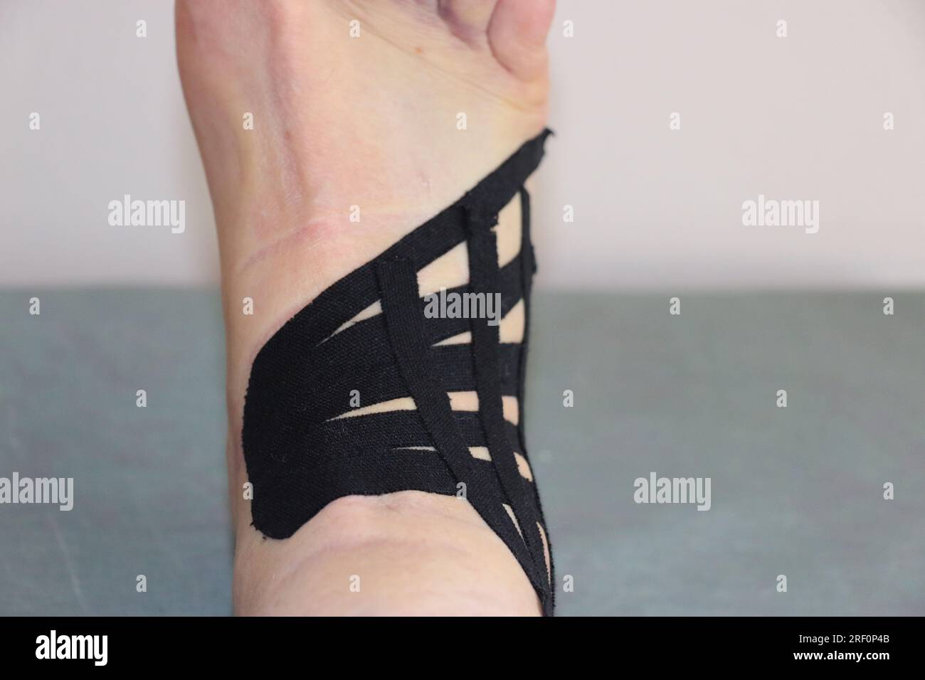 Pied de femme avec bandages croisés pour une entorse à la cheville. Le pied et les orteils présentent une ecchymose et des ecchymoses. Banque D'Images