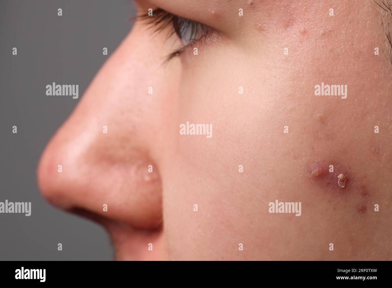 Jeune homme avec problème d'acné sur fond gris, vue rapprochée Banque D'Images
