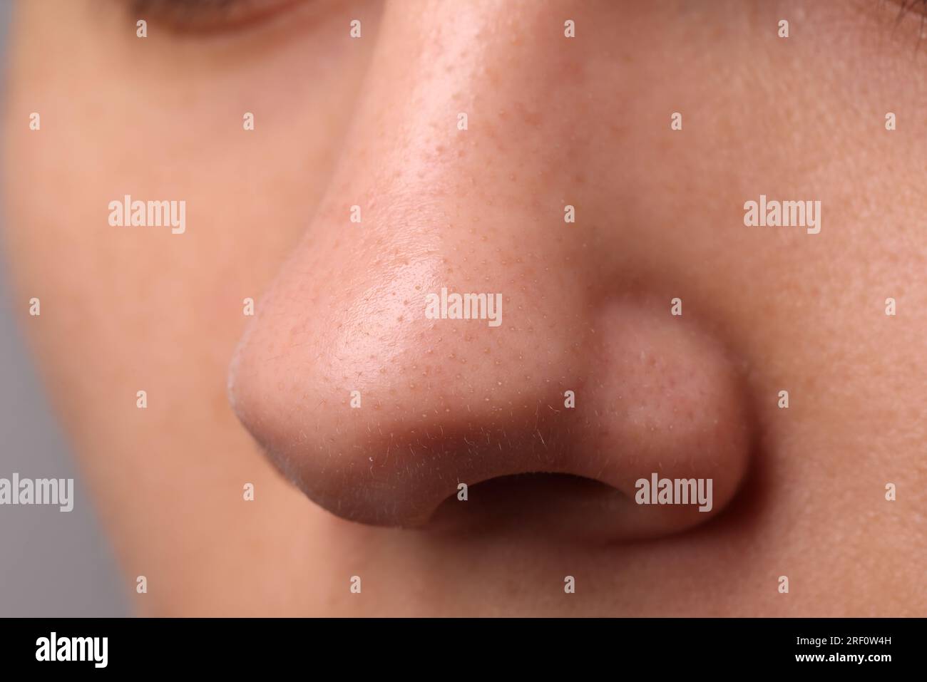 Jeune femme avec problème d'acné, vue rapprochée du nez Banque D'Images