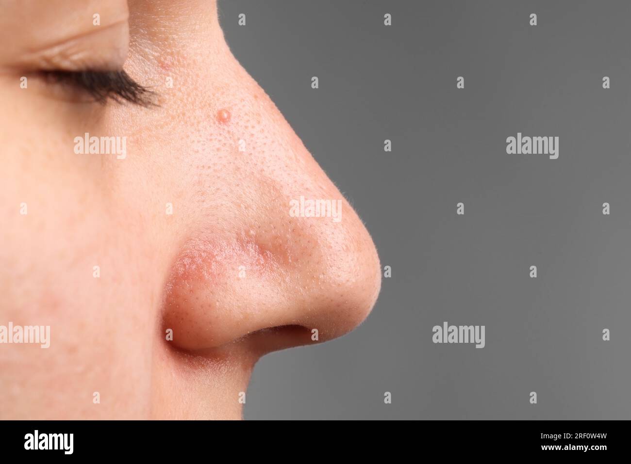 Jeune femme avec problème d'acné sur fond gris, gros plan. Espace pour le texte Banque D'Images