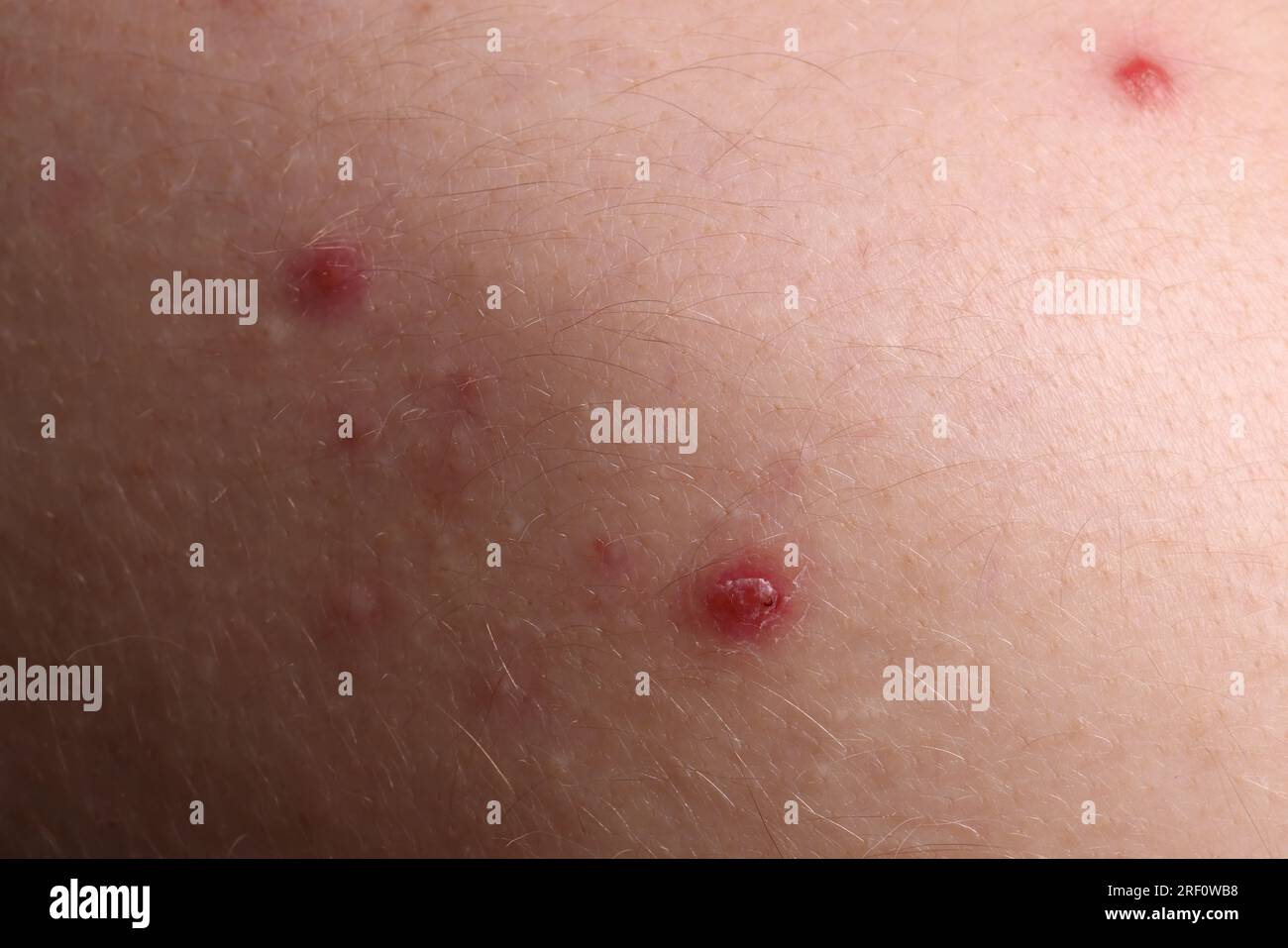 Jeune personne avec problème d'acné, vue rapprochée de la peau Banque D'Images