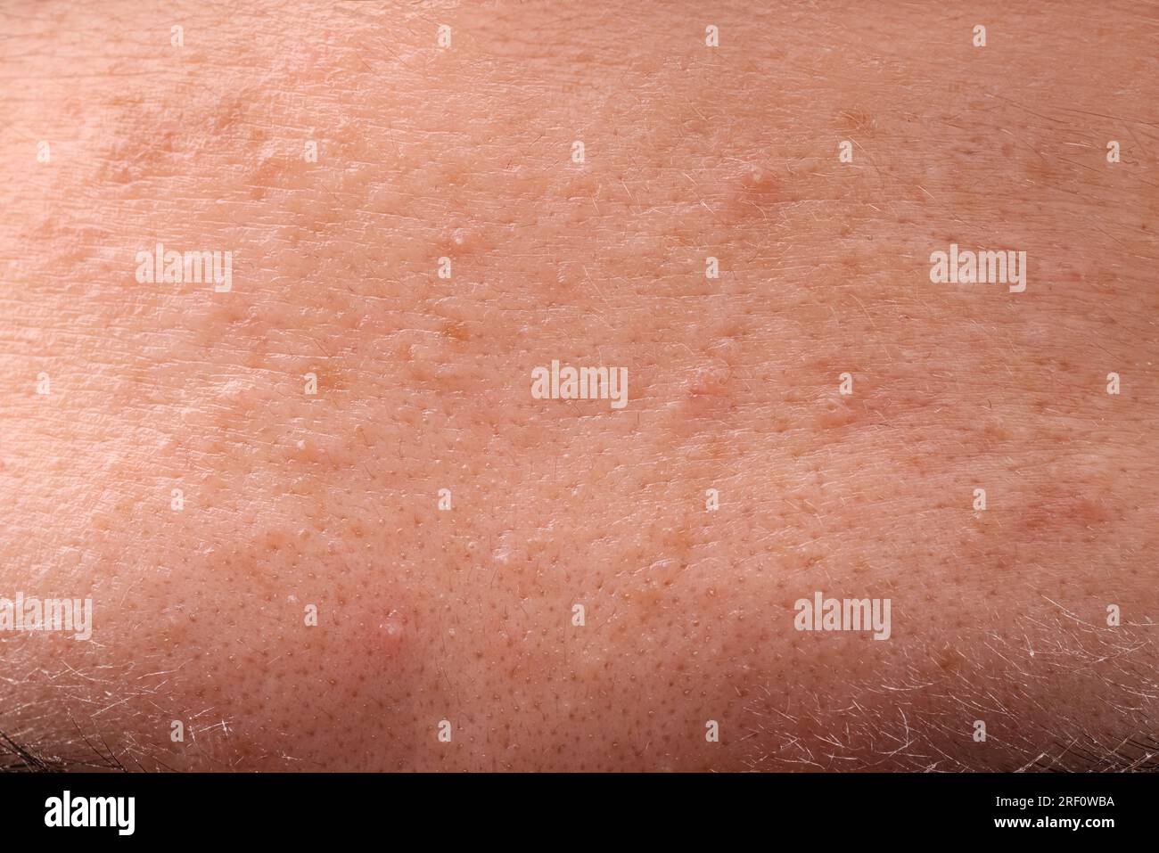 Jeune femme avec problème d'acné, vue rapprochée Banque D'Images