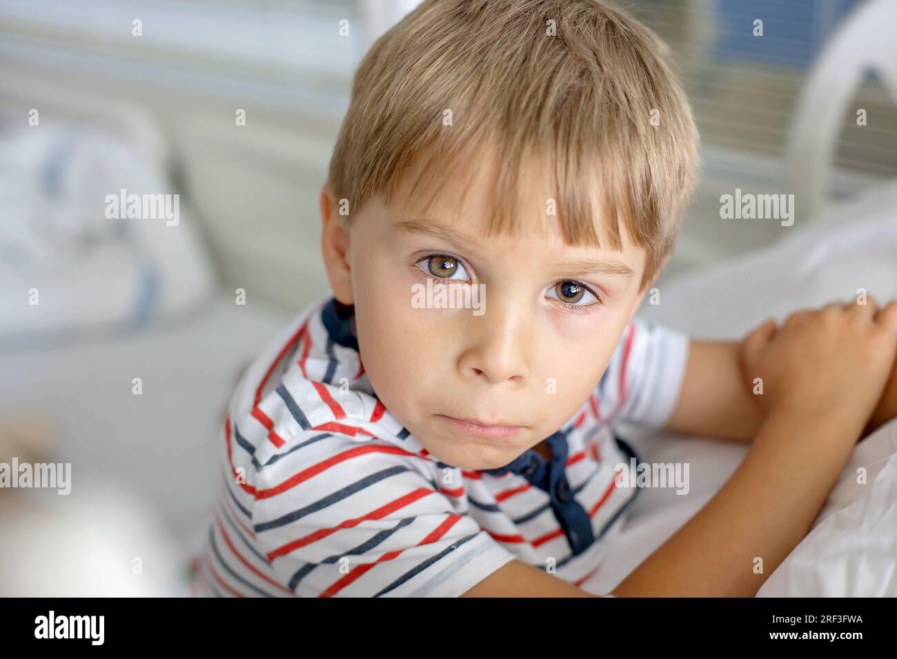 Petit enfant préscolaire à l'hôpital, avec dilatation de pupille od un oeil pour examen médical après gouttes oculaires, après accident Banque D'Images