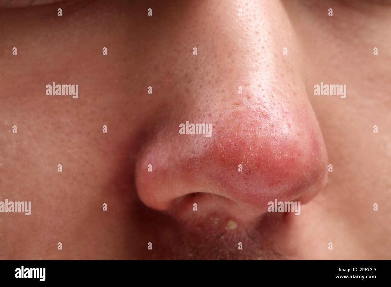 Jeune homme avec problème d'acné, vue rapprochée du nez Banque D'Images