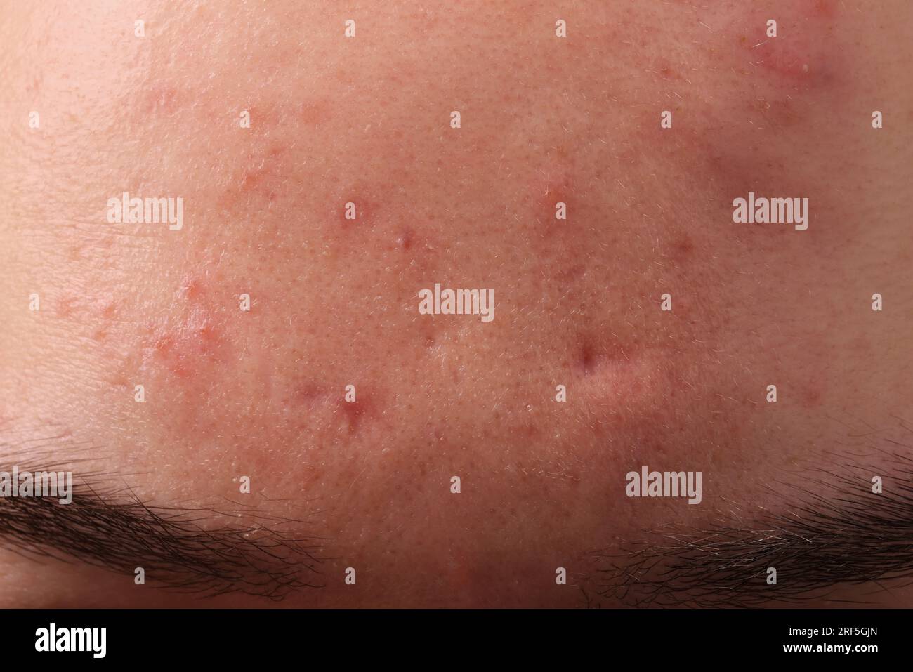 Jeune homme avec problème d'acné, vue rapprochée du front Banque D'Images