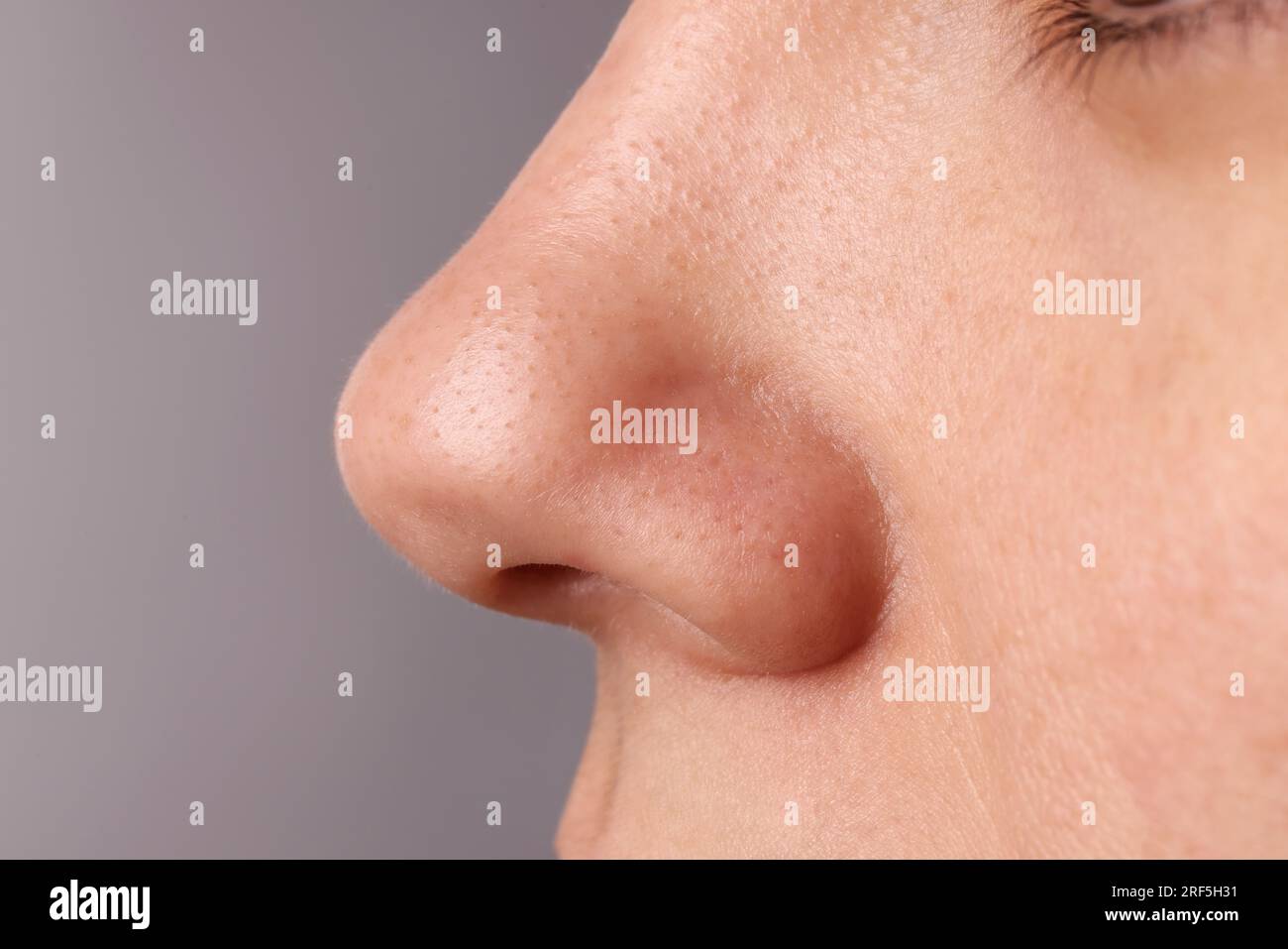 Jeune femme avec problème d'acné sur fond gris, gros plan Banque D'Images