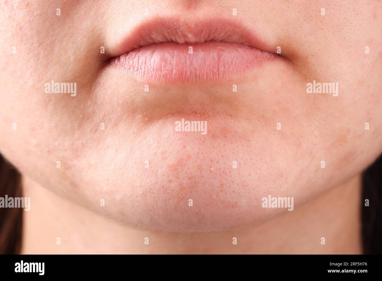 Jeune femme avec problème d'acné, vue rapprochée Banque D'Images