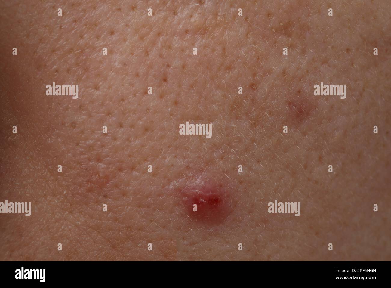 Jeune femme avec l'acné sur son visage, gros plan Banque D'Images