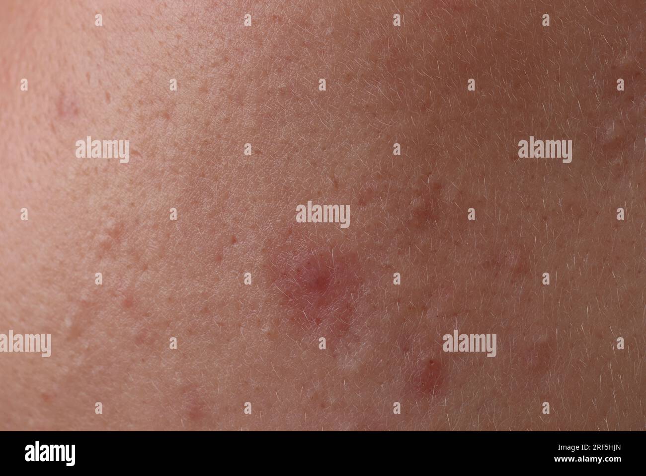 Jeune femme avec l'acné sur son visage, gros plan Banque D'Images