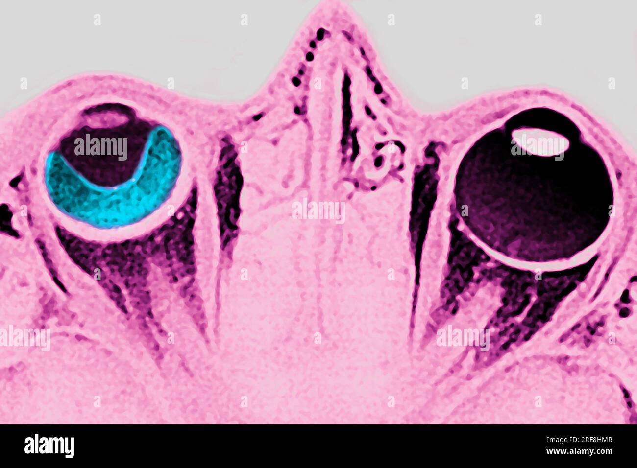 Décollement de rétine de l'oeil gauche, visualisé par IRM en coupe radiale. Banque D'Images