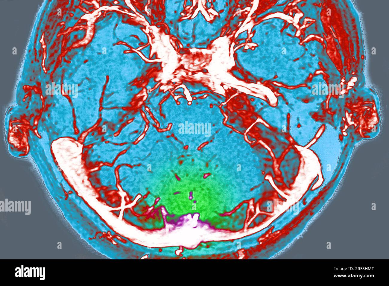 Thrombose des sinus veineux cérébraux de la dure-mère, visualisée par angiographie cranienne en IRM. Banque D'Images