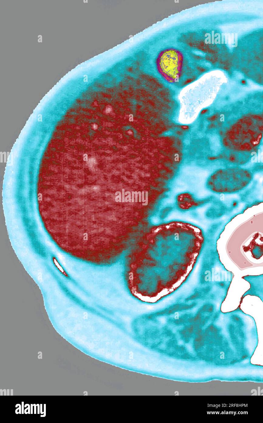 Lymphomes révélés par une adénopathie entre le foie et la vésicule biliaire. scintigraphie abdominale en coupe radiale. Banque D'Images