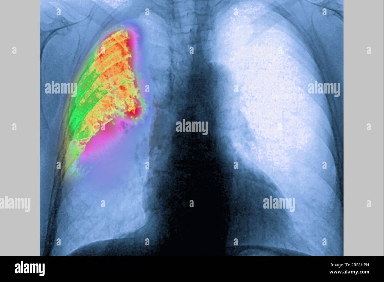 Pneumonie du poumon droit (infection respiratoire aiguë) révélée par une radiographie thoracique frontale. Banque D'Images
