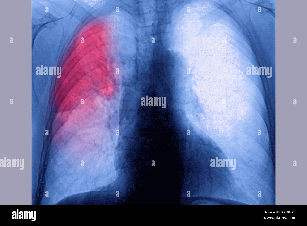Pneumonie du poumon droit (infection respiratoire aiguë) révélée par une radiographie thoracique frontale. Banque D'Images