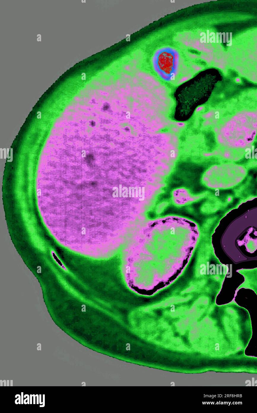 Lymphomes révélés par une adénopathie entre le foie et la vésicule biliaire. scintigraphie abdominale en coupe radiale. Banque D'Images