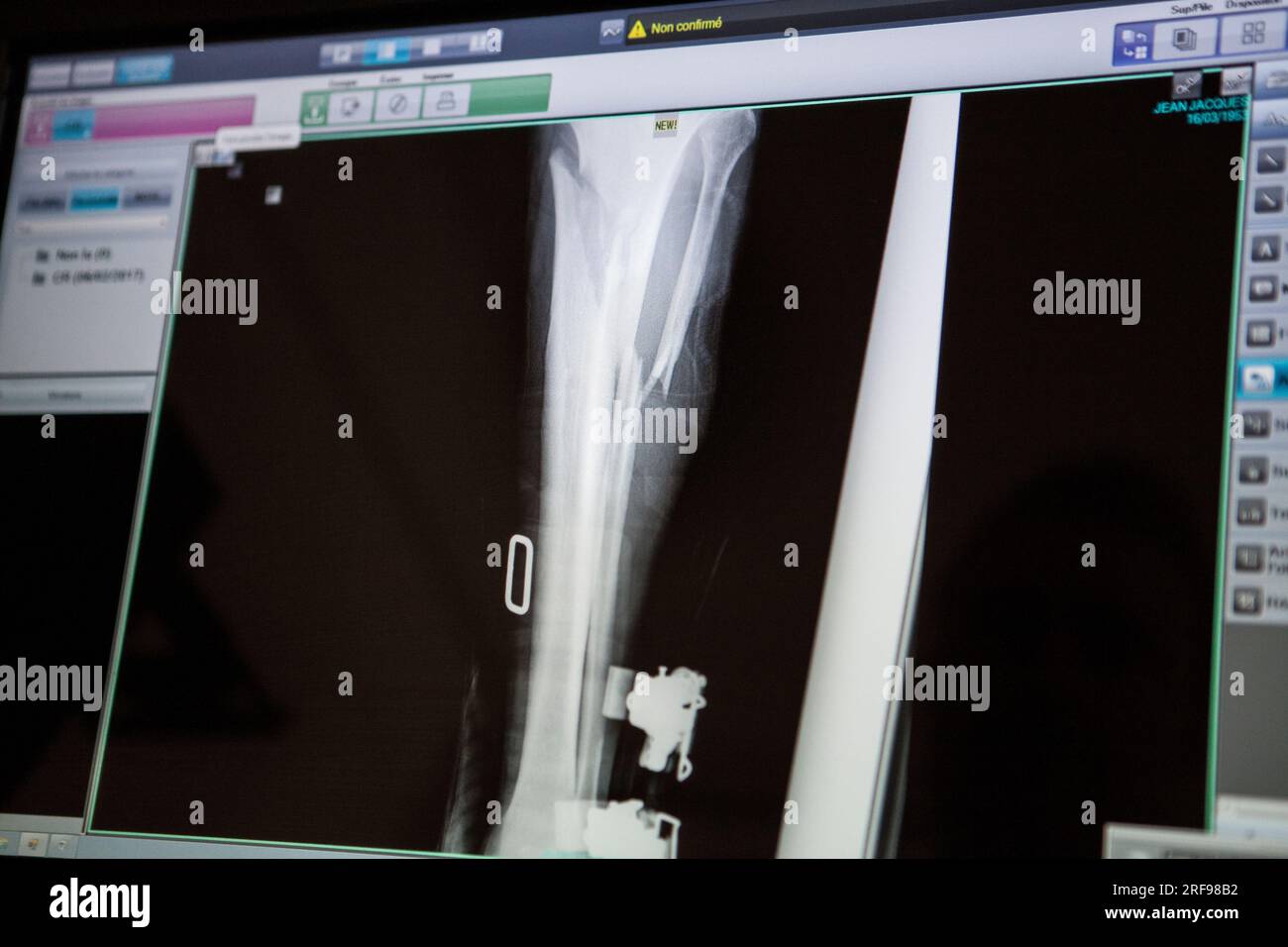 Radiographie de la jambe d'un patient ayant subi une chute de ski avec fracture du tibia et du péroné. Banque D'Images