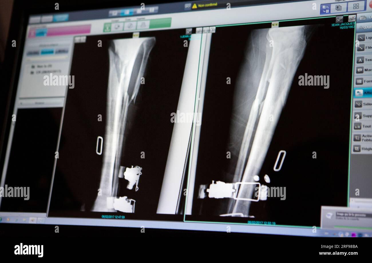 Radiographie de la jambe d'un patient ayant subi une chute de ski avec fracture du tibia et du péroné. Banque D'Images