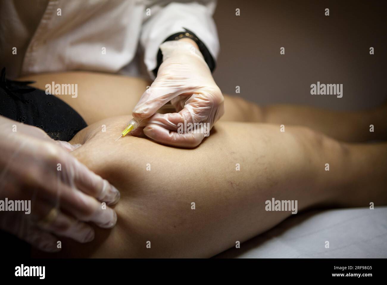 Traitement de la cellulite et des vergetures par carboxythérapie, ou injection sous-cutanée de dioxyde de carbone. Banque D'Images