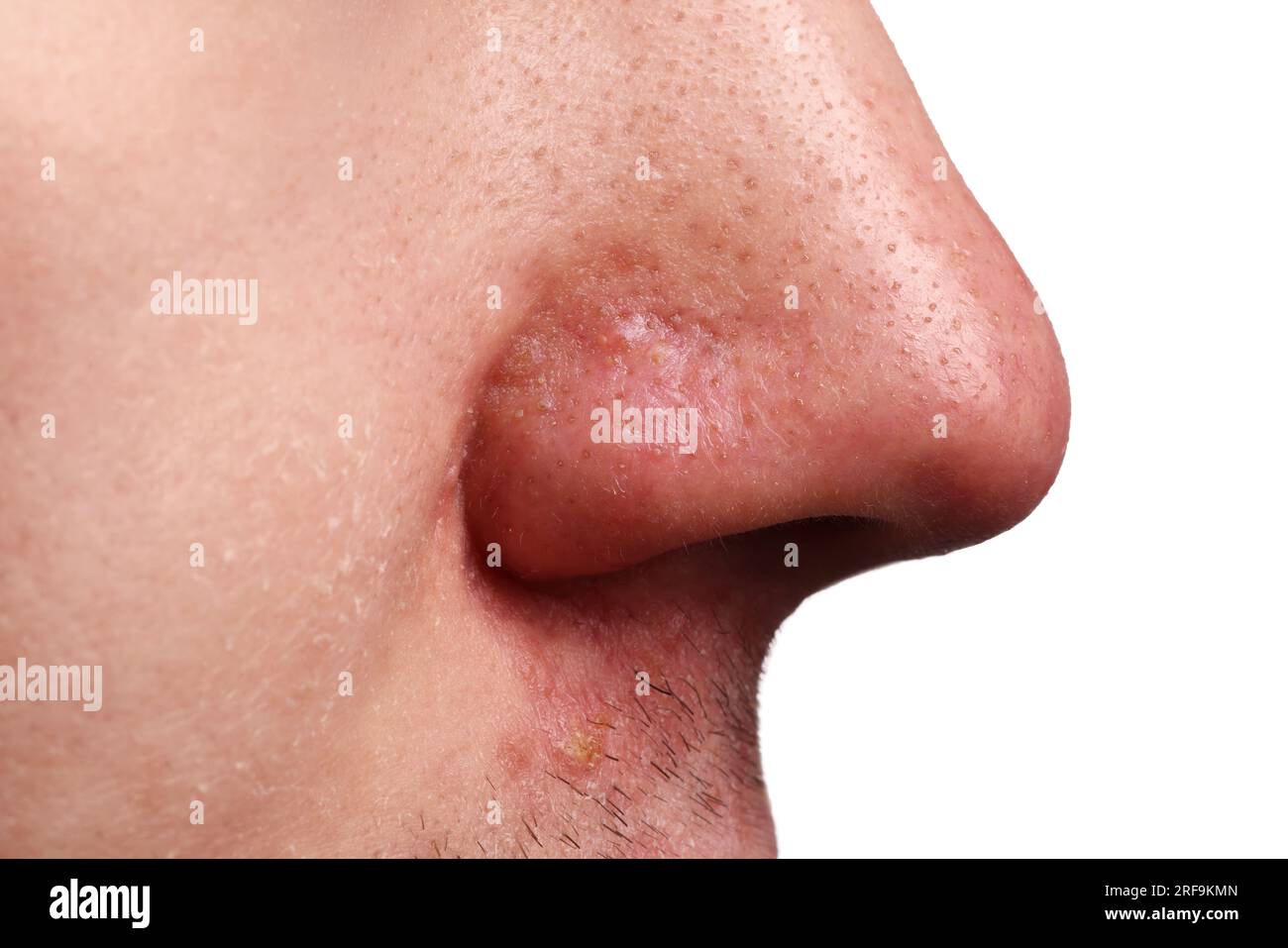 Jeune homme avec problème d'acné sur fond blanc, vue rapprochée du nez Banque D'Images