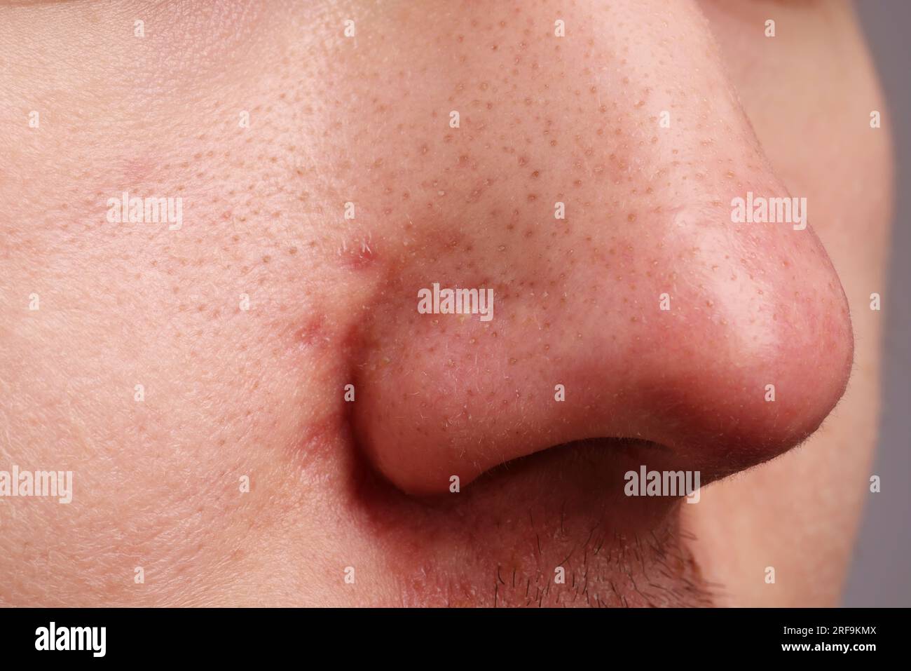 Jeune homme avec problème d'acné, vue rapprochée du nez Banque D'Images