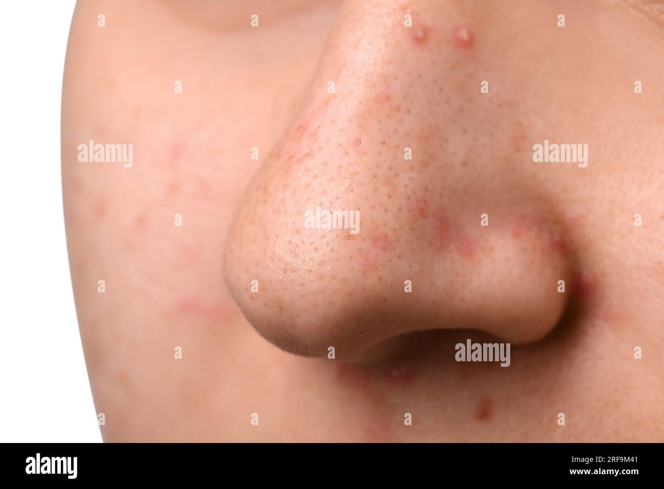 Jeune femme avec problème d'acné, vue rapprochée du nez Banque D'Images