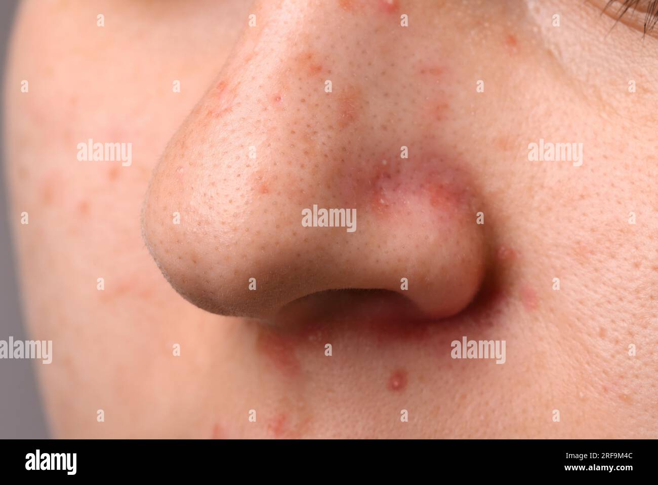 Jeune femme avec problème d'acné, vue rapprochée du nez Banque D'Images