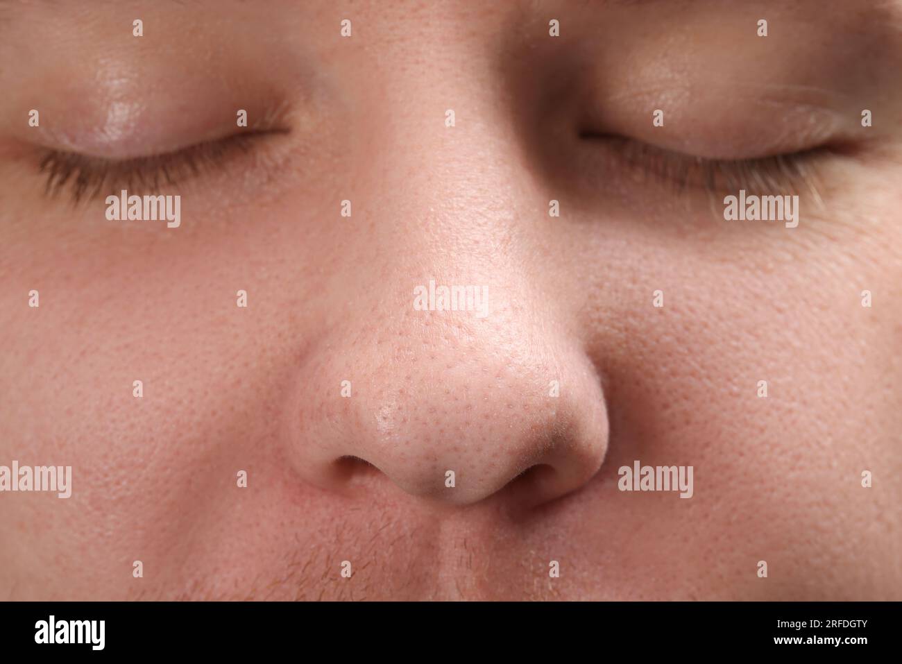 Jeune homme avec problème d'acné, vue rapprochée du nez Banque D'Images