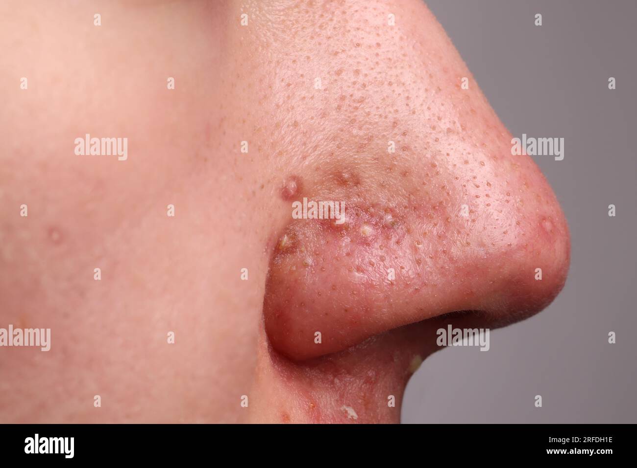 Jeune homme avec problème d'acné sur fond gris, vue rapprochée du nez Banque D'Images