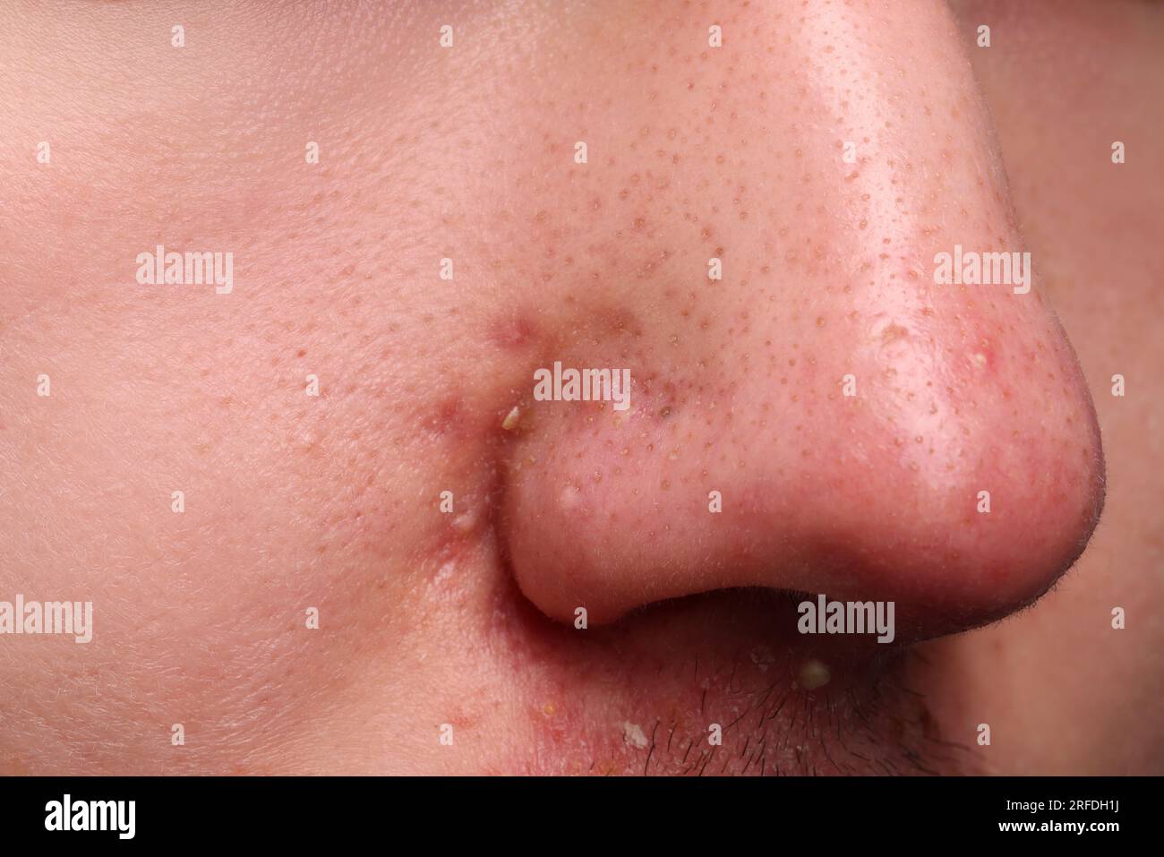 Jeune homme avec problème d'acné, vue rapprochée du nez Banque D'Images