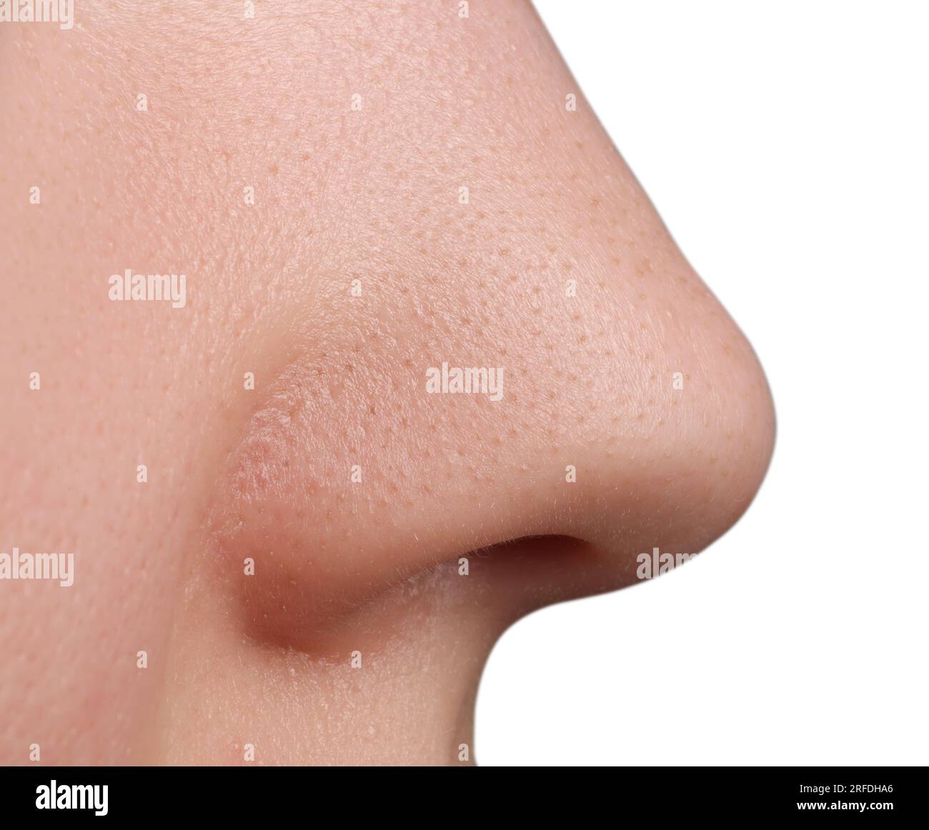 Jeune femme avec problème d'acné sur fond blanc, vue rapprochée du nez Banque D'Images