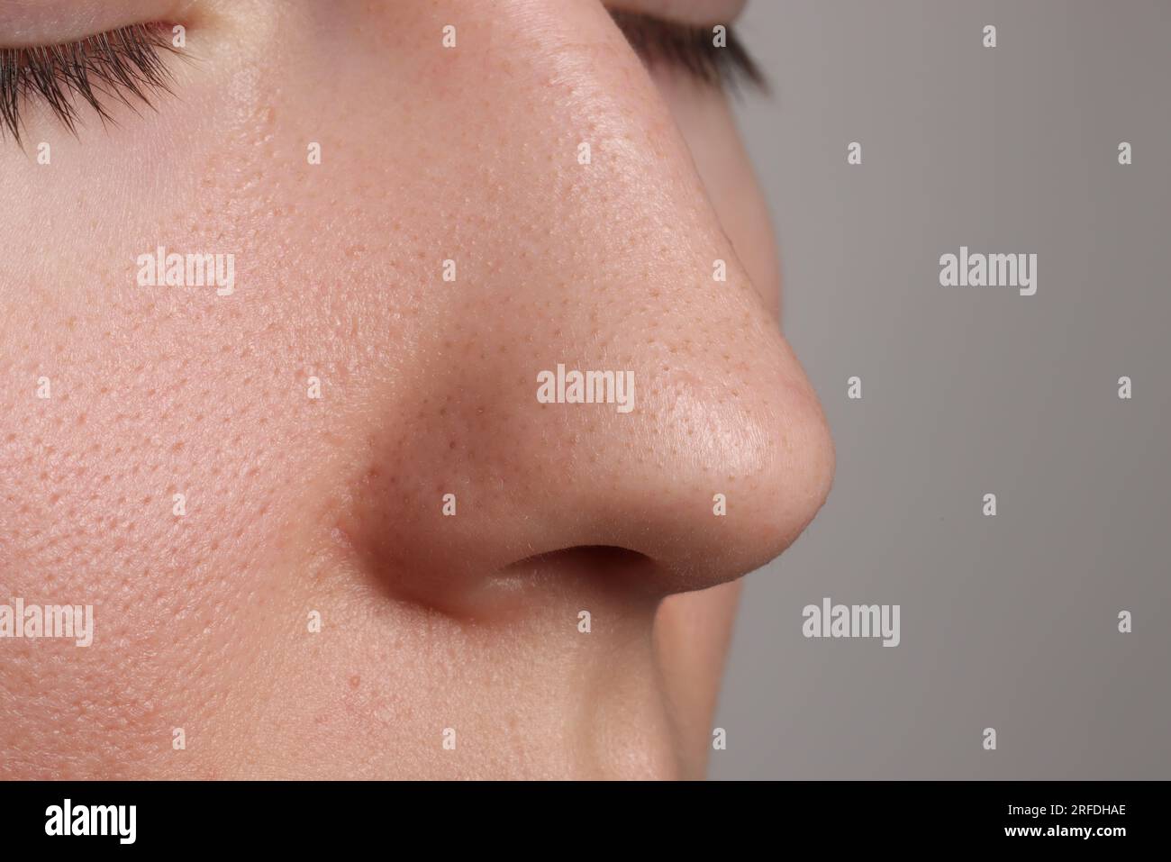 Jeune femme avec problème d'acné sur fond gris, vue rapprochée du nez. Espace pour le texte Banque D'Images