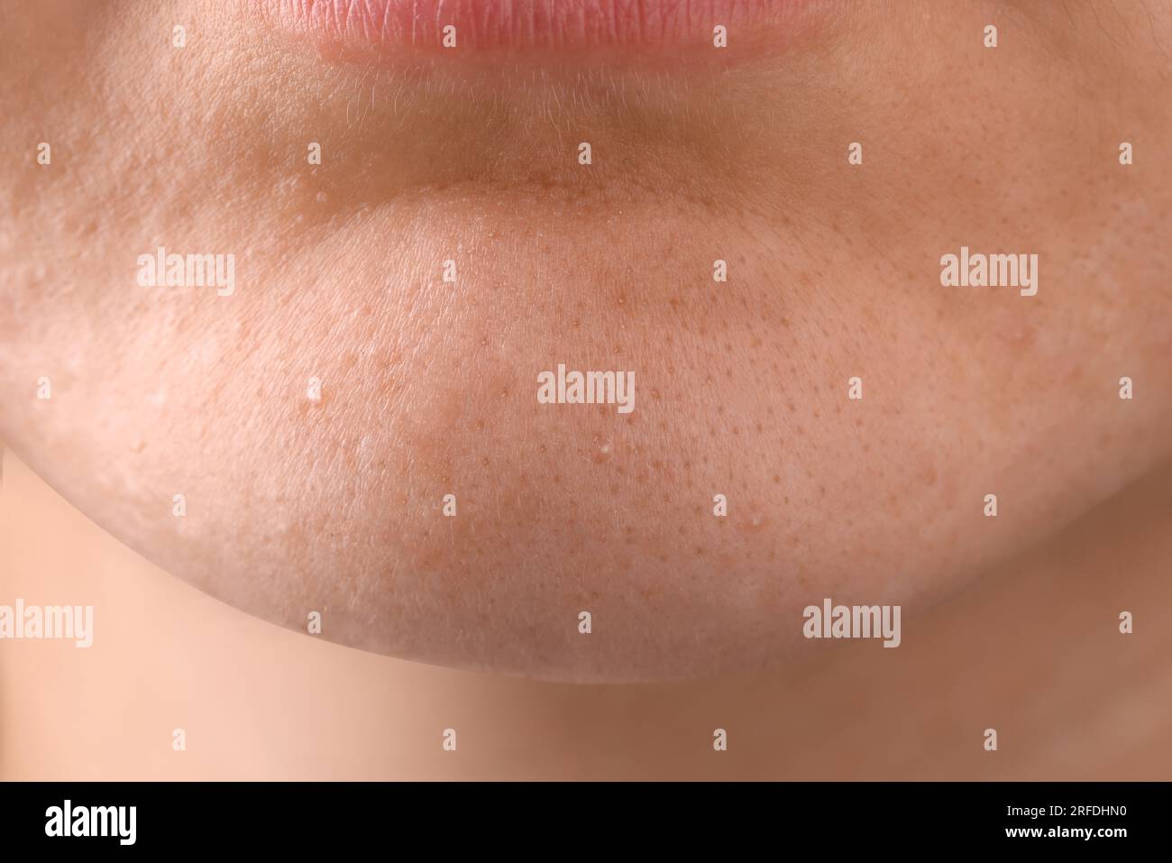 Jeune femme avec problème d'acné, vue rapprochée Banque D'Images
