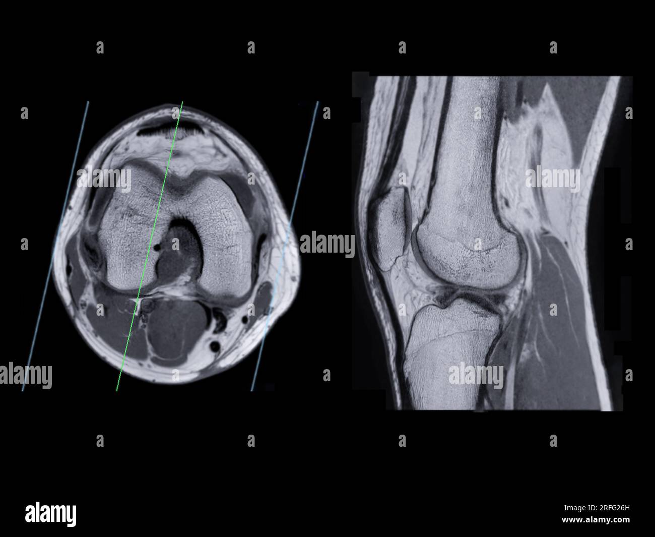 Imagerie par résonance magnétique ou IRM de l'articulation du genou PDW axial et sagittal pour détecter la déchirure ou l'entorse du ligament croisé antérieur (LCA) Banque D'Images