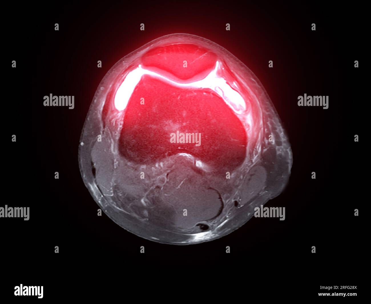 Imagerie par résonance magnétique ou IRM de l'articulation du genou vue axiale T2 FS pour détecter les déchirures ou entorses du ligament croisé antérieur (LCA) Banque D'Images
