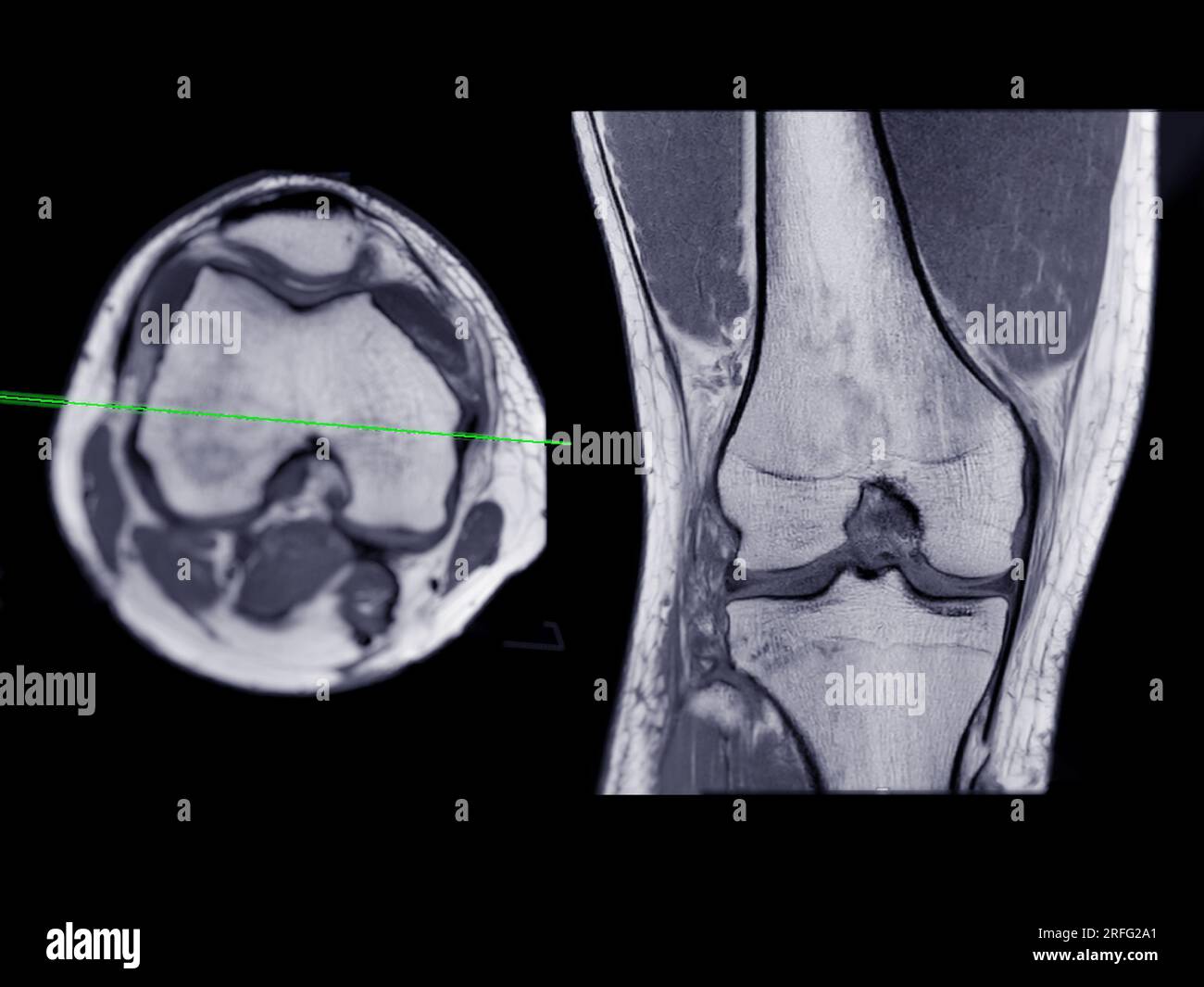 Imagerie par résonance magnétique ou IRM de l'articulation du genou vue axiale T2 et coronale pour détecter les déchirures ou entorses du ligament croisé antérieur (LCA) Banque D'Images