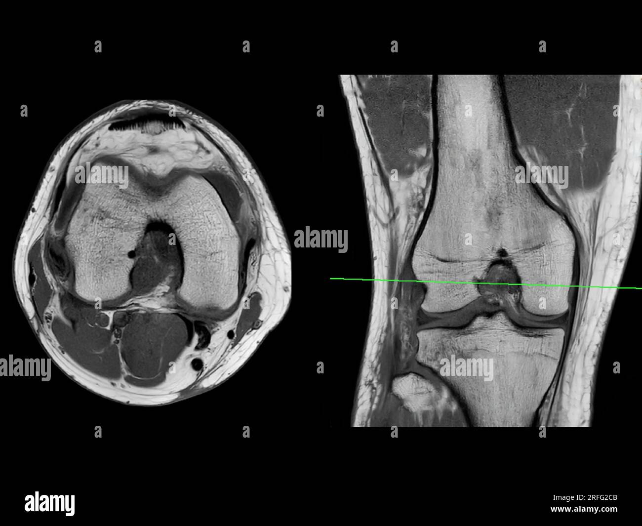 Imagerie par résonance magnétique ou IRM de l'articulation du genou vue axiale T2 et coronale pour détecter les déchirures ou entorses du ligament croisé antérieur (LCA) Banque D'Images