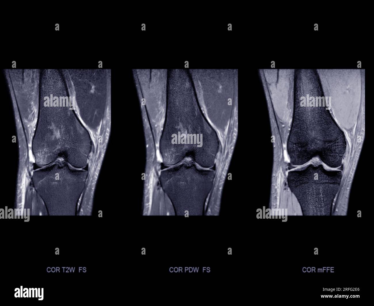Imagerie par résonance magnétique ou IRM de l'articulation du genou Corona ; T2 FS , PDW et gradient pour détecter la déchirure ou l'entorse du ligament croisé antérieur (LCA) Banque D'Images