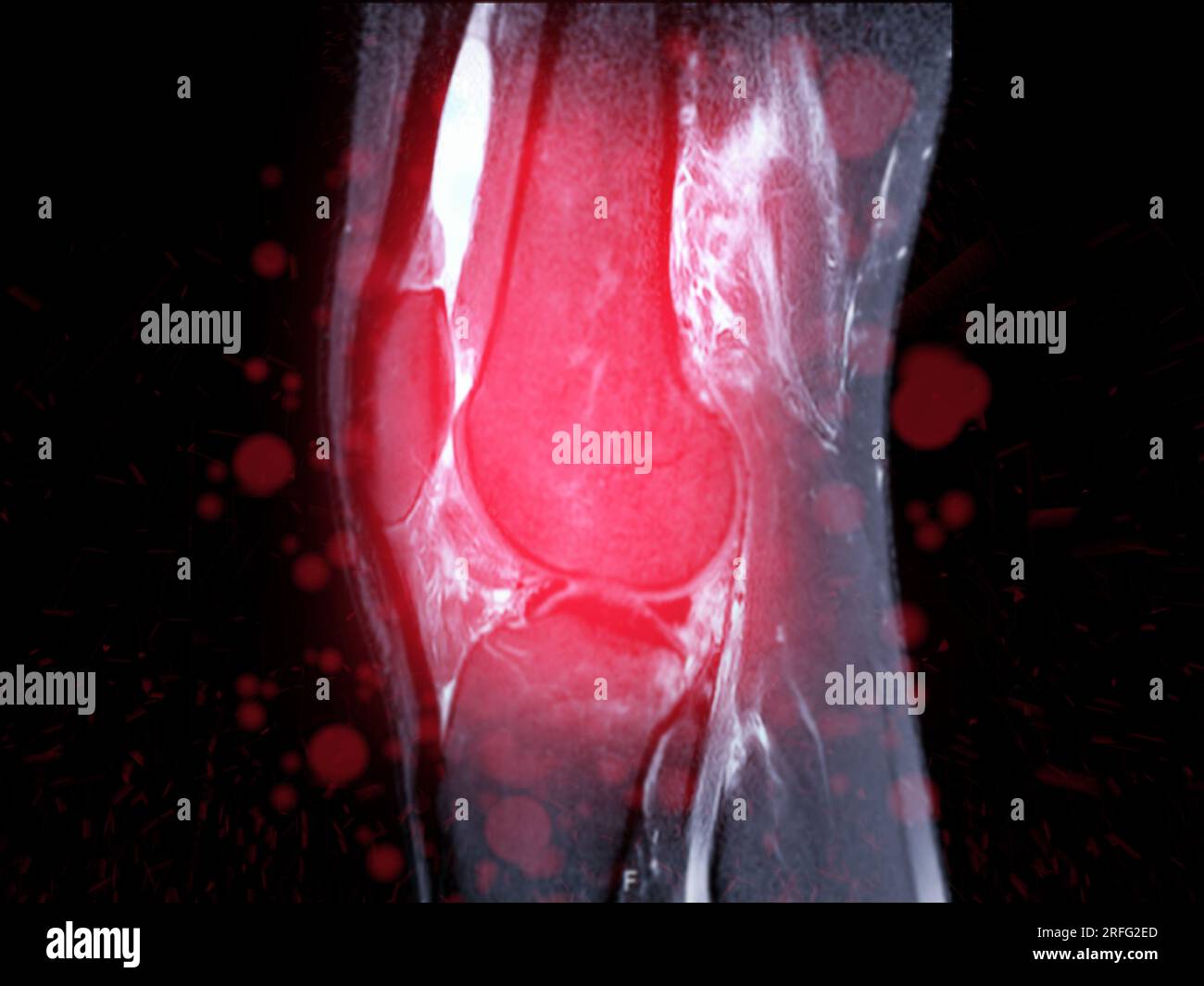 Imagerie par résonance magnétique ou IRM de l'articulation du genou Sagittal T2 FS pour détecter les déchirures ou entorses du ligament croisé antérieur (LCA) Banque D'Images