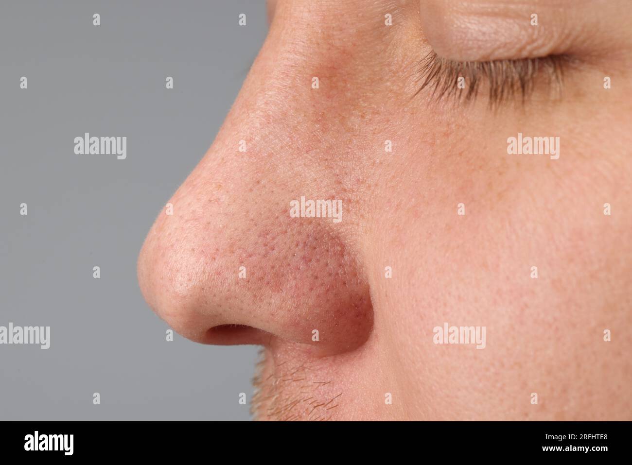 Jeune homme avec problème d'acné sur fond gris, gros plan Banque D'Images