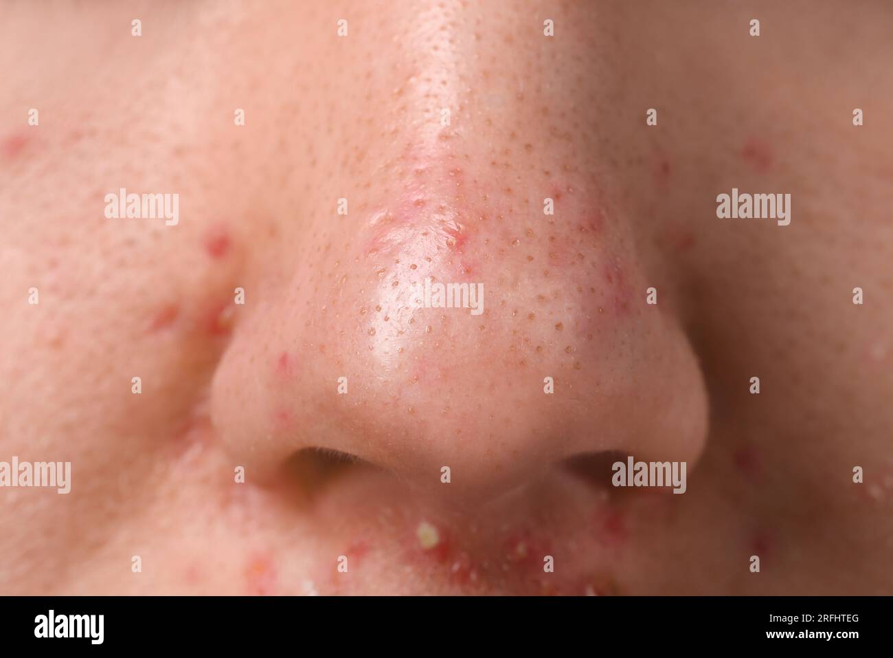 Jeune homme avec problème d'acné, vue rapprochée du nez Banque D'Images