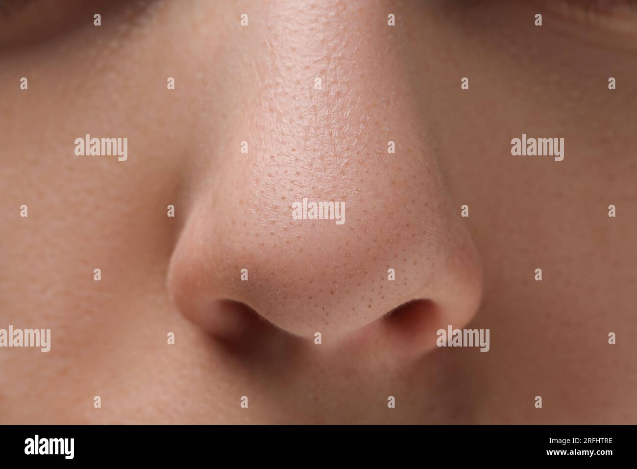 Jeune femme avec problème d'acné, vue rapprochée du nez Banque D'Images